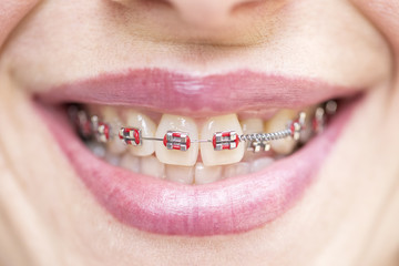 Orthodontic braces. Dentist and orthodontist concept.