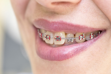 Woman showing her  teeth with  braces. Dentist and orthodontist concept