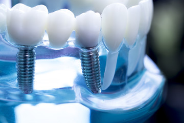 Dentist dental teeth implant