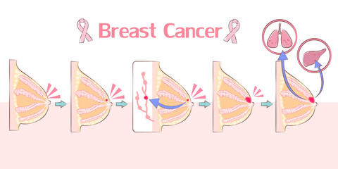 cartoon breast cancer concept