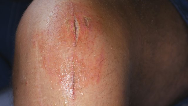 Infected Foot Wound Ready for Clean and Disinfect Procedure 