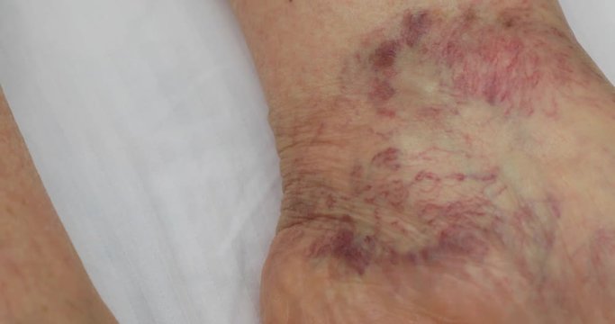 Senior leg with venous insufficiency