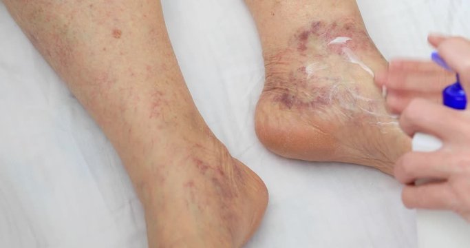 Senior leg with venous insufficiency