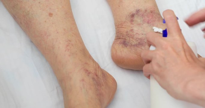 Senior leg with venous insufficiency