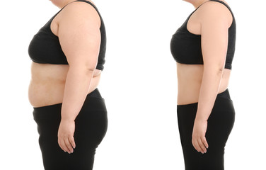 Young woman before and after liposuction operation on white background, side view. Cosmetic surgery