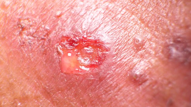 Wound Macro Shot
