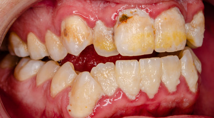 serious dental plaque, frontal teeth intraoral