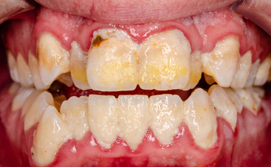 serious dental plaque, frontal teeth intraoral