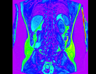 Frontal abdomen MRI scan of 60 year old male patient with kidney stone