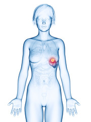 Naklejka premium medically accurate 3d rendering of a female´s spleen cancer