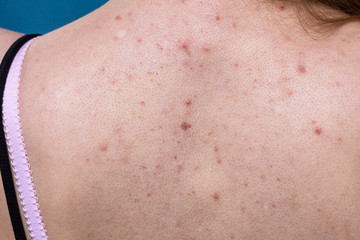 Fototapeta premium woman with skin problem acne on back