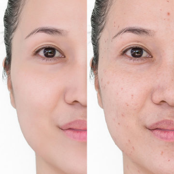 Before and after laser treatment