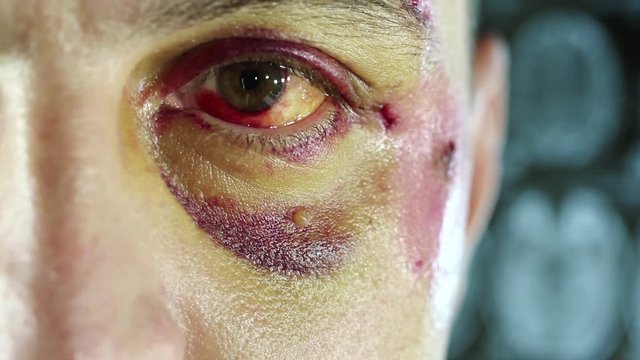 Trauma of face, hematoma of left eye, man with injury of face looks at the camera in medical center, roentgenogram of head at background. It is not a make-up, real trauma after falling off a bicycle