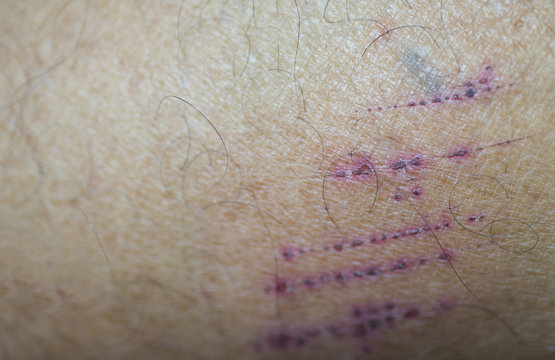 Scab skin lesions