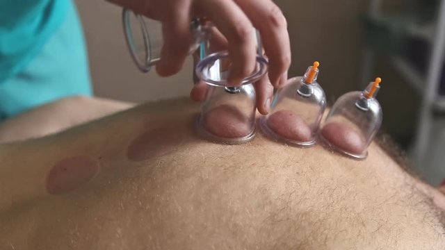 Therapist giving vacuum cupping therapy to man's back in the clinic