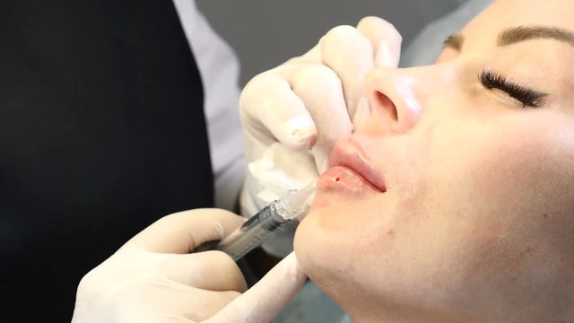 Lip augmentation medical procedure. Close up of young woman getting botox injection in health care clinic. 4k