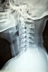 Close up x-ray film show cervical spine or c-spine, neck bones x-ray film. radiology to educate...