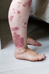 Close up ill allergic rash, eczema skin of patient , atopic dermatitis symptom skin detail texture , Fungus of skin ,The concept dermatology, treatment. Red spots on psoriasis skin. Feet of a woman