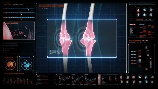 Human medical care center, main control room, Arthritis of pain Knee. Healthy joint and unhealthy painful joint with osteoarthritis in digital display. 4k animation.2