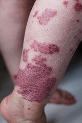Close up ill allergic rash, eczema skin of patient , atopic dermatitis symptom skin detail texture...