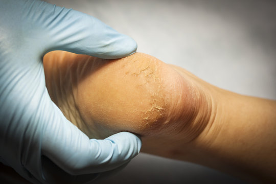 the doctor examines the patient's leg in blue gloves. The heel is all blistered and cracked. close-up