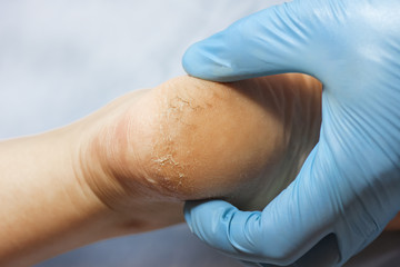 the doctor examines the patient's leg in blue gloves. The heel is all blistered and cracked. close-up