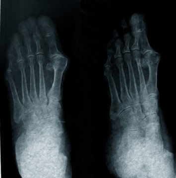 radiography of foot