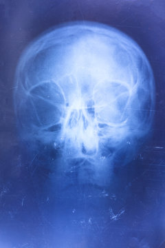 X-ray of the skull. retro shot. possibly concussion