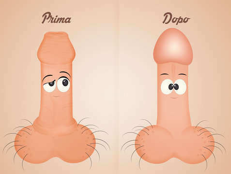 before and after circumcision