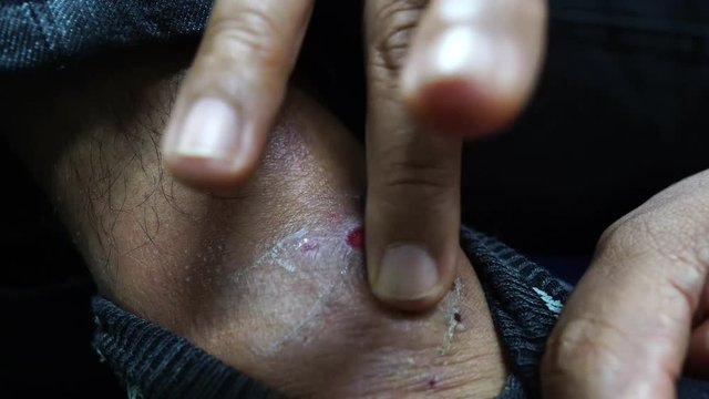 4K Men are rubbing foot for medicines, skin diseases