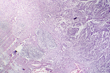 Mucinous carcinoma of the stomach, light micrograph, photo under microscope