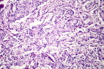 Mucinous carcinoma of the stomach, light micrograph, photo under microscope