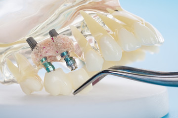 Fototapeta na wymiar implant and orthodontic model for student to learning teaching model showing teeth.