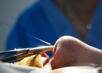 close up of nose surgery procedure in the hospital.