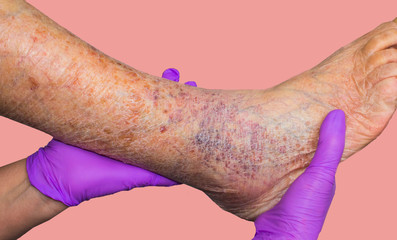 Close-up of skin with varicose veins on senior male leg. Concept of dry skin, old senior people,...