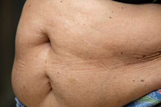 Senior women body fat belly front view, Sterilization scar, Black moles, Unhealthy concept
