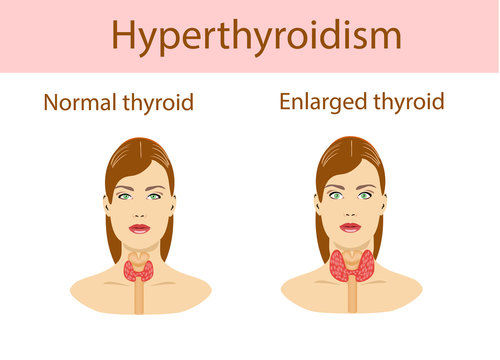 Hyperthyroid Images – Browse 985 Stock Photos, Vectors, and Video | Adobe Stock