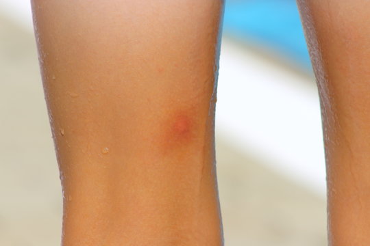 Mückenstich dicker fuß nach Wie gefährlich