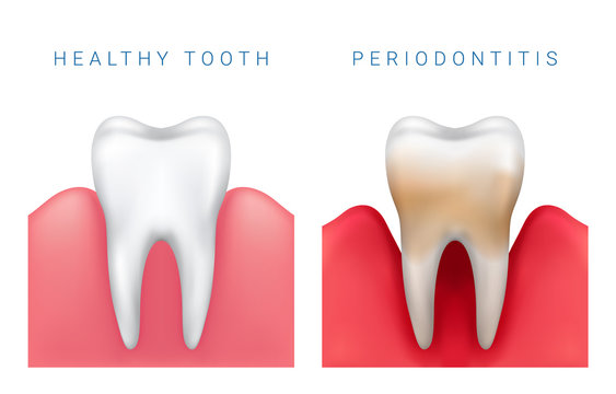 Vector medical illustration of realistic healthy tooth and periodontitis disease