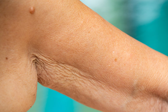 Senior woman raising her wrinkled inside part of the arm and wrinkled armpit, Mole, Blue swimming pool background, Body concept, Close up