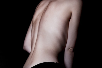 A girl with anorexia turned back, spine and ribs visible. Toned in cold tones for dramatic effect. - obrazy, fototapety, plakaty