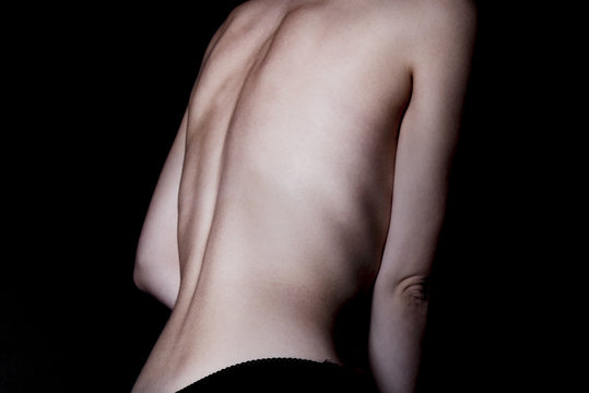 A girl with anorexia turned back, spine and ribs visible. Toned in cold tones for dramatic effect.