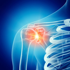 3d rendered medically accurate illustration of a painful shoulder joint