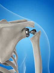 3d rendered medically accurate illustration of a shoulder replacement