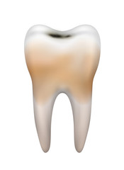 Vector realistic illustration of dirty unhealthy tooth with dental caries isolated on white background