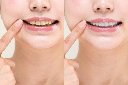 歯の比較