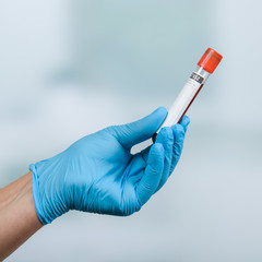 Hand mit medizinischem Handschuh hält Blutprobe