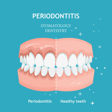 Periodontitis vector. Recession gums treatment. Stomatology dentistry concept