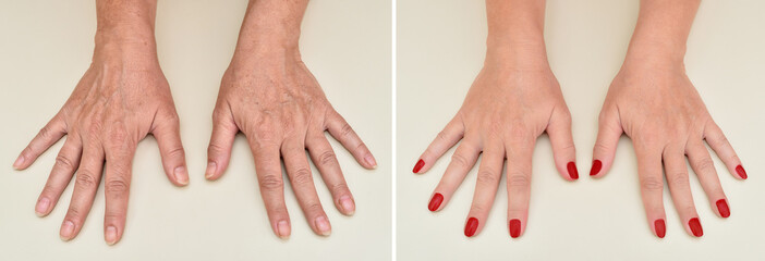 Hands of the same middle aged woman before and after manicure and skin treatment 