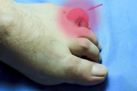 Gå en tur Måling At the toe is deformed. people are disabled. the finger is very sore  Stock-foto | Adobe Stock